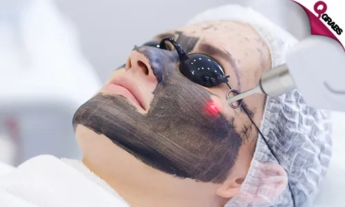 Carbon Laser Treatment!